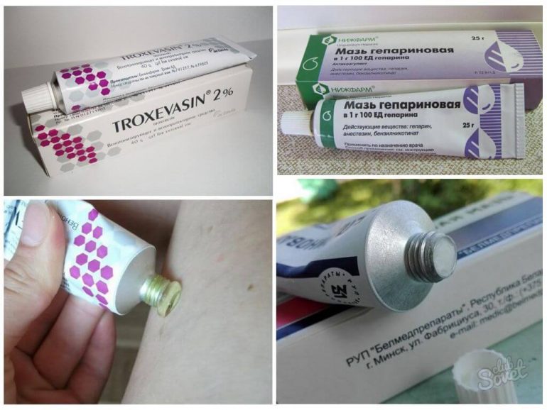 Как убрать вены на ногах