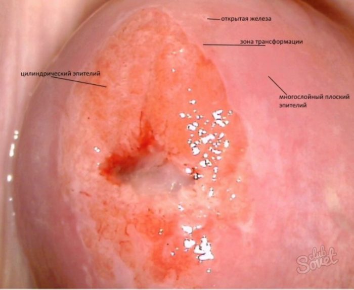Як виглядає нездорова шийка матки? Як виглядає нездорова шийка матки?