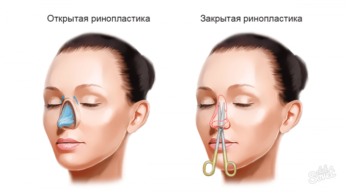 Как убрать горбинку на носу