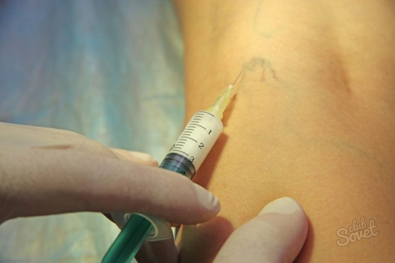 Как убрать вены на ногах