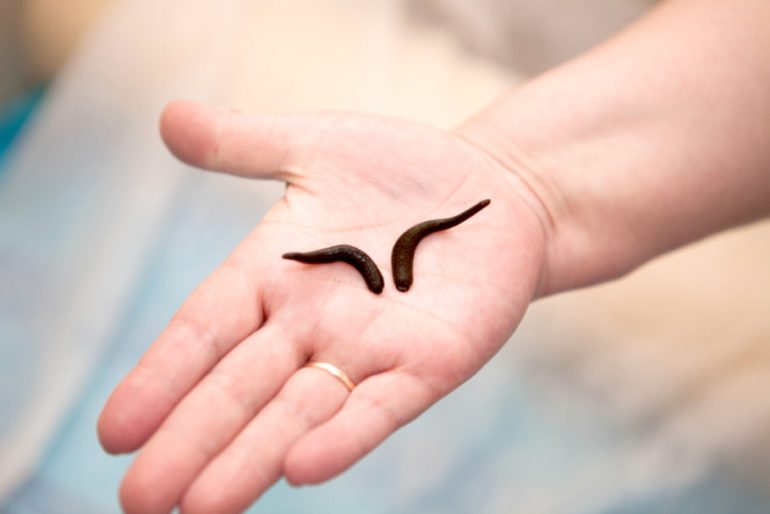 Гірудотерапія: користь і шкода Гірудотерапія: користь і шкода