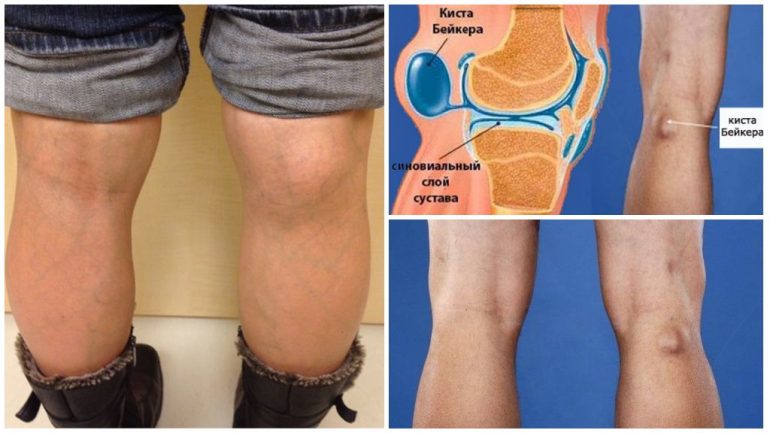Кіста Бейкера Кіста Бейкера