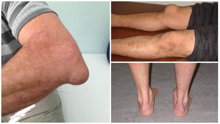 Що таке бурсит. Чим і як його лікувати Що таке бурсит. Чим і як його лікувати