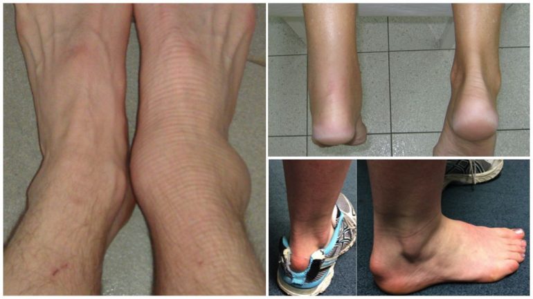 Ознаки бурситу різних суглобів Ознаки бурситу різних суглобів