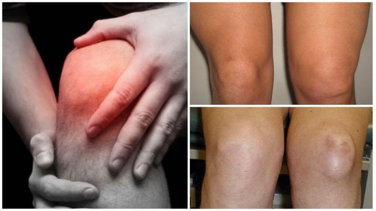 Зв'язок синовіту з бурситом Зв'язок синовіту з бурситом