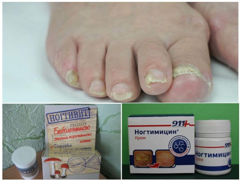 Лікування запущеної форми грибка нігтів на ногах – засоби, опис та відгуки