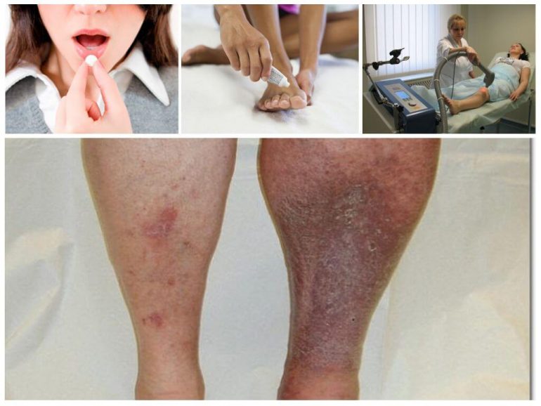 лікування варикозного дерматиту лікування варикозного дерматиту
