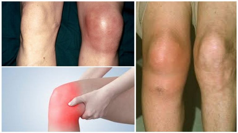 Гусячий бурсит Гусячий бурсит