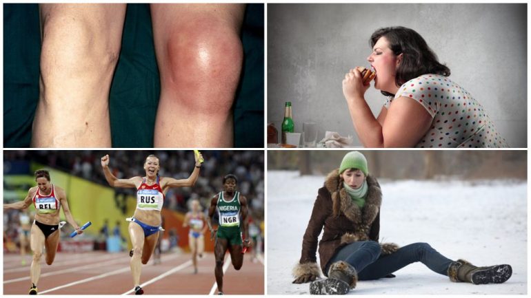 Бурсит гусячої лапки колінного суглоба – симптоми і лікування Бурсит гусячої лапки колінного суглоба – симптоми і лікування