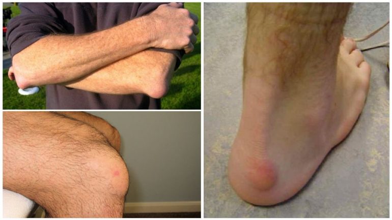 Ознаки бурситу різних суглобів Ознаки бурситу різних суглобів