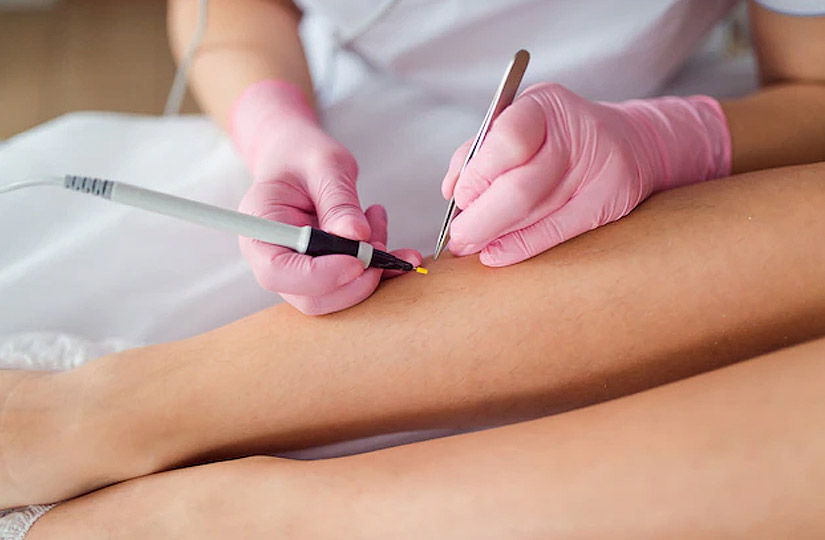 Чи можна видалити волосся назавжди і який вид епіляції краще вибрати – лазер, IPL чи ELOS