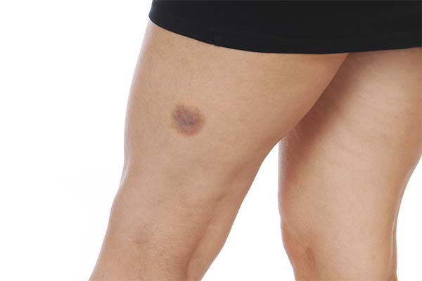 До чого сняться великі, товсті або худі стегна — 53 тлумачення з різних сонників.