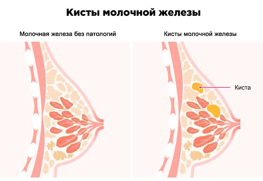 Киста молочной железы