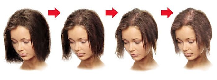 Вся правда про алопецію