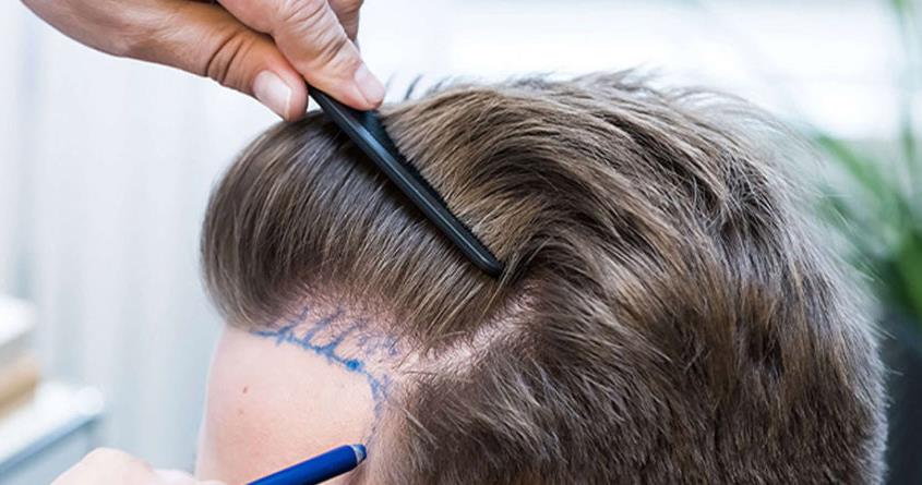 Трансплантація волосся у Туреччині