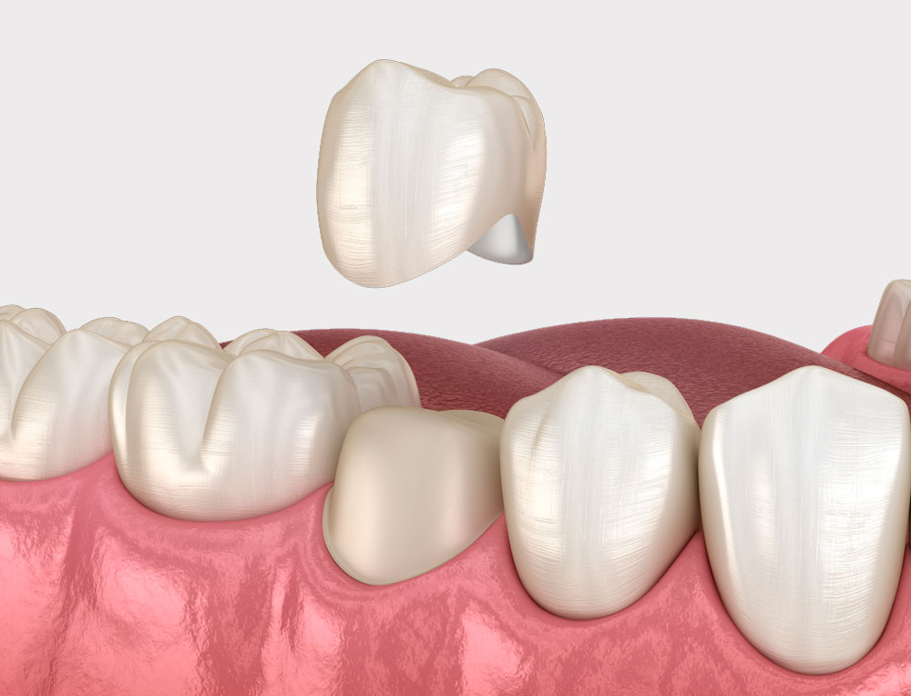 8 преимуществ керамических коронок