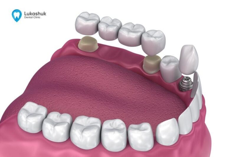 Виды зубных имплантов
