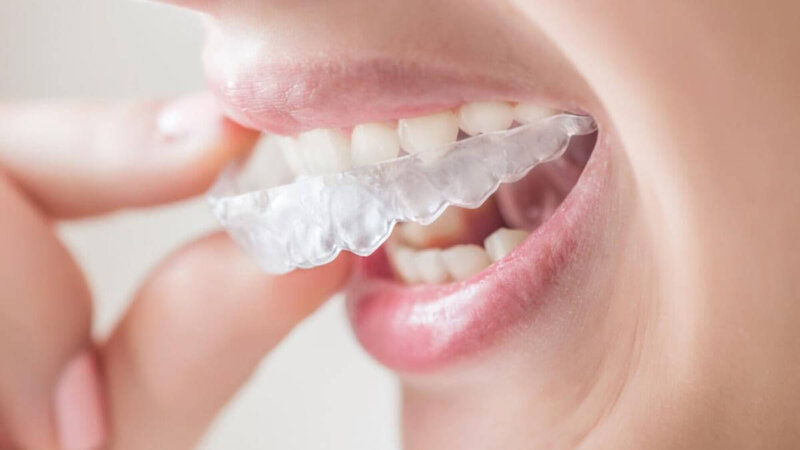 Елайнери Invisalign