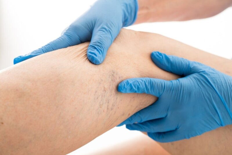 Як запобігати виникненню варикозу у жінок