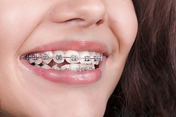 Поставити брекети Київ