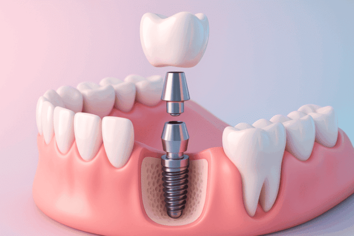 Встановлення зубних імплантів