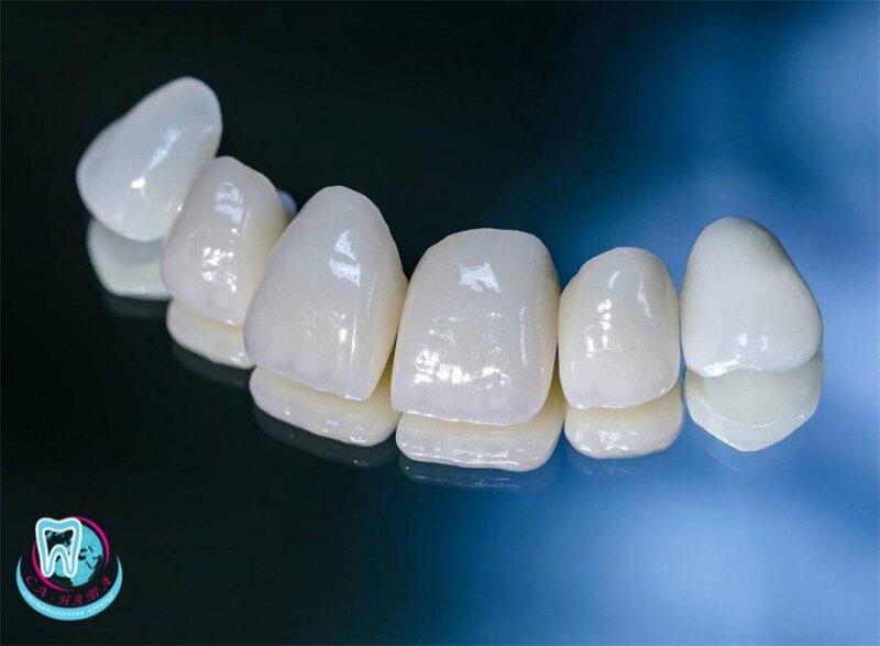 Корекція зубів за допомогою вінірів