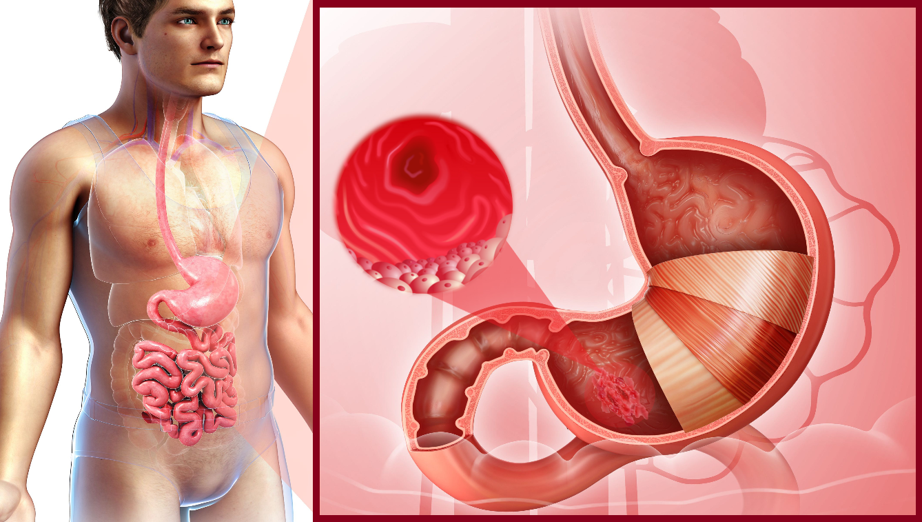 Лікування гастриту у Києві: клінічні рішення в межах доказової медицини